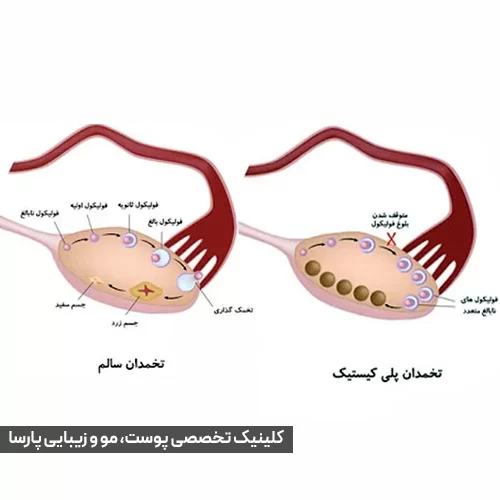 تفاوت تخمدان سالم و پلی کیستیک