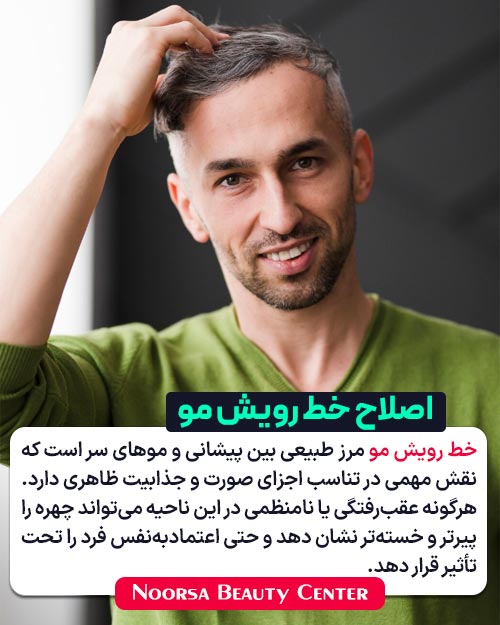 اصلاح خط رویش مو با کاشت موی طبیعی