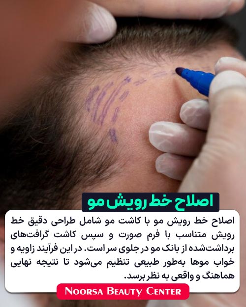 اصلاح خط رویش مو با کاشت مو