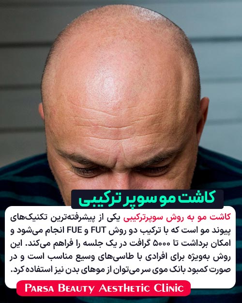 کاشت مو به روش سوپر ترکیبی چیست