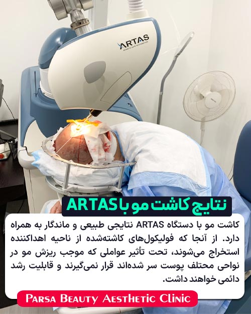 نتایج کاشت مو با دستگاه آرتاس