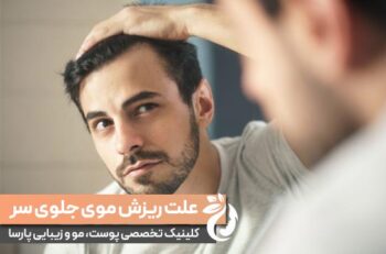 علت ریزش موی جلوی سر