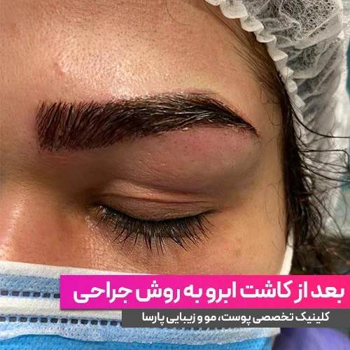 کاشت ابرو به روش جراحی