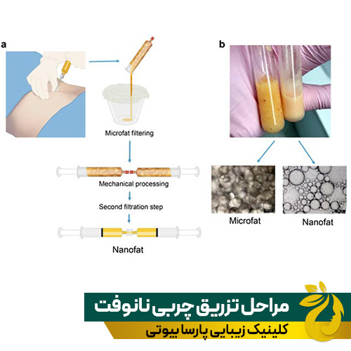 مراحل تزریق چربی به روش نانوفت