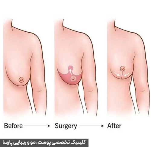 مراحل لیفت سینه