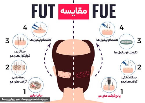 تفاوت FUT با FUE