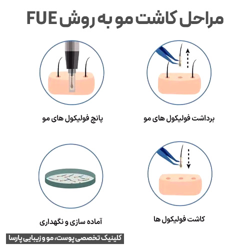 مراحل کاشت مو به روش FUE