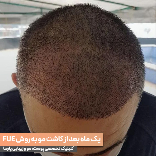 کاشت مو به روش FUE