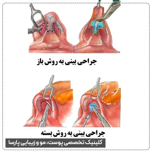 مقایسه جراحی بینی باز و بسته