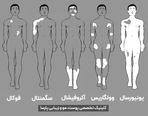 انواع ویتیلیگو