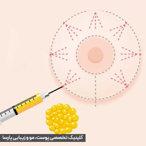 تزریق چربی به سینه