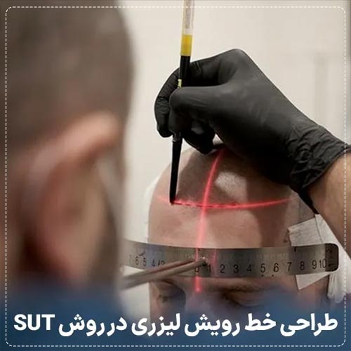 طراحی خط رویش مو لیزری