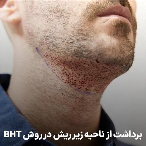 برداشت از ناحیه زیر ریش در روش BHT