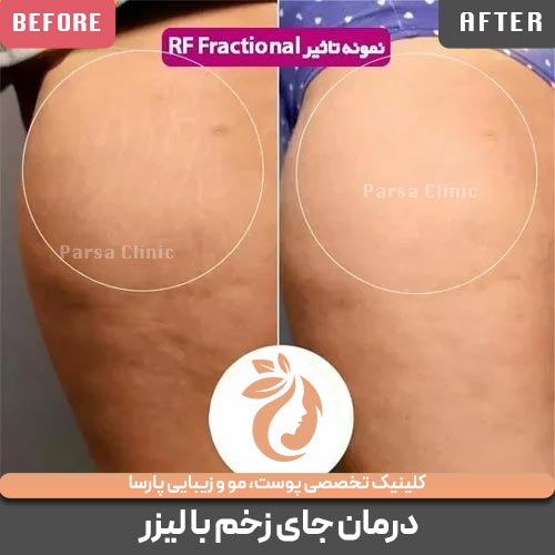 تاثیر لیزر RF فرکشنال