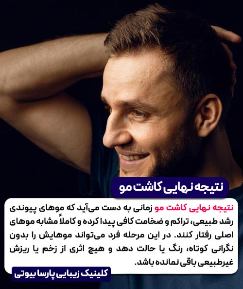 نتیجه نهایی کاشت مو