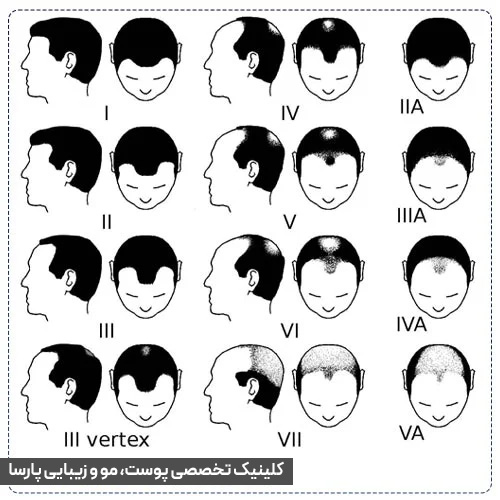 انواع الگوی ریزش مو