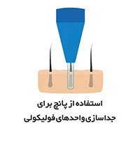 استخراج فولیکول مو