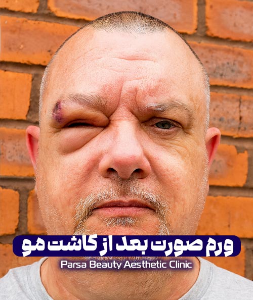 ورم صورت بعد از کاشت مو