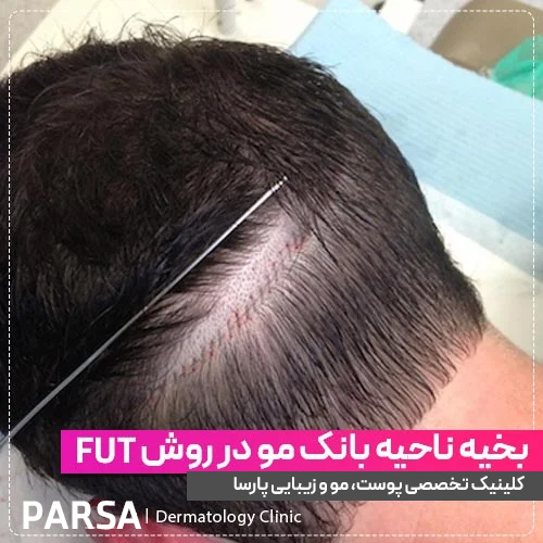 خط بخیه کاشت مو در روش FUT