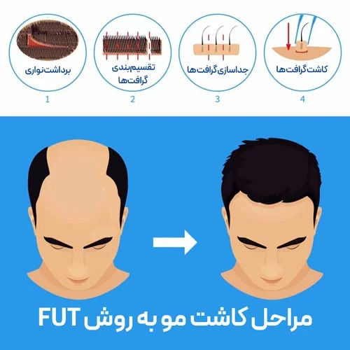 مراحل کاشت مو به روش FUT