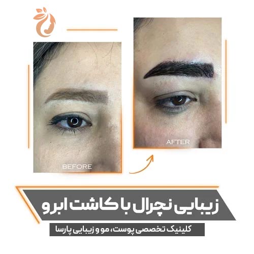 کاشت ابروی نچرال