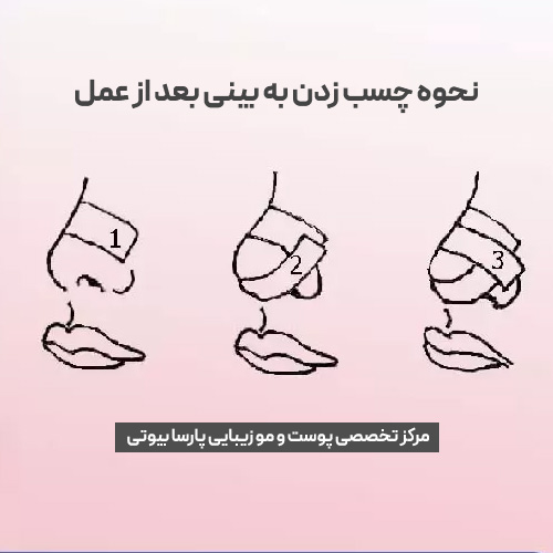 مراجل چسب زدن به بینی