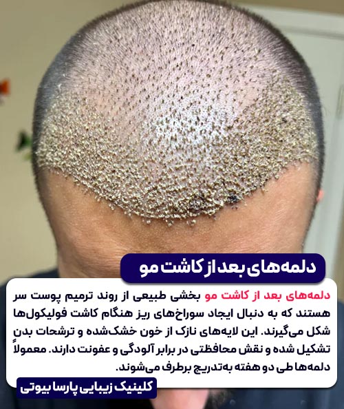 دلمه های بعد از کاشت مو
